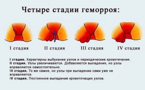 Послеродовой геморрой: симптомы и лечение